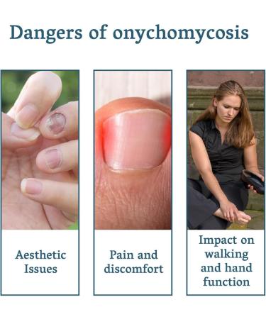 Fungal Nail Treatment - Extra Strong Nail Fungus Treatment for Toenail and Fingernail - Fungal Nail Eliminator Anti fungus Nail Repair and Strengthen Fix & Renew Damaged Broken Nails 30ml - Buy Online on GoSupps.com