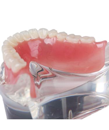 Dental Teeth Model - Lower Removable Overdenture with 2 Implants | Dentist Assistant Supplies - International Shipping - Buy Online on GoSupps.com
