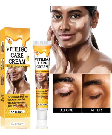 Crsetmyth Vitiligo Care Cream Skin Lightening and Repair Treatment 50ml - Buy Online on GoSupps.com