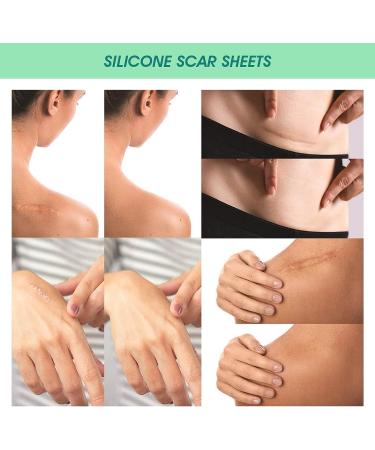 Silicone Scar Removal Sheets for C-Section Surgery, Burns, Acne, Keloids & Stretch Marks - Washable & Reusable - Effective on Old & New Scars - 4 Pack - Buy Online on GoSupps.com