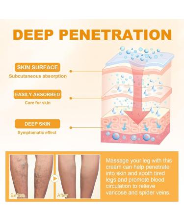 Miracle Cream for Varicose Veins Vitamin K Formula Varicose Relief Cream Vein Repair Cream Relieves Leg Fatigue Moisturizes and Promotes Blood Circulation - Buy Online on GoSupps.com