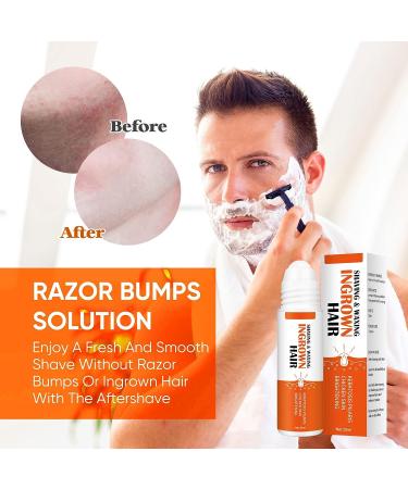 Ingrown Hair Treatment & Razor Bumps Stopper Serum - Alcohol-Free After Shave Solution for Men and Women - Face, Neck, Bikini, Legs, and Underarms - Buy Online on GoSupps.com