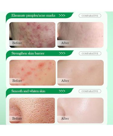 Salicylic Acid Acne Cream 50g - 3% BHA Spot Cream for Acne - Blackhead Remover - Dark Spot Remover for Face - Scar Removal Cream - Moisturizing Face Cream for Women - Pimple Cream for Redness - Buy Online on GoSupps.com