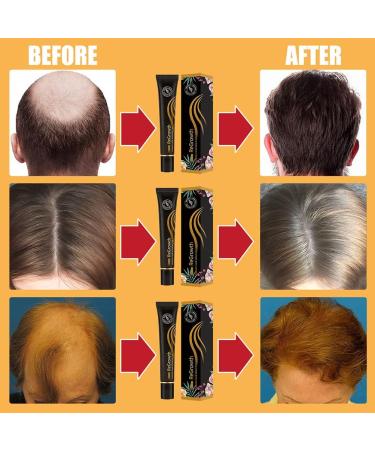 Regrowth Organic Hair Serum Roller Set Scalp Intense Roll-On Hair Growth Serum Biotin Hair Growth Serum for Men and Women of All Hair Types - Buy Online on GoSupps.com