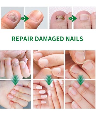 FLLUOUZH 3 Pieces 7 Days Ginger Nail Ginger Nail Treatment Nail Support Nail Care Ginger Nail Growth Serum Ginger Cuticle Care Oil for Nails - Buy Online on GoSupps.com