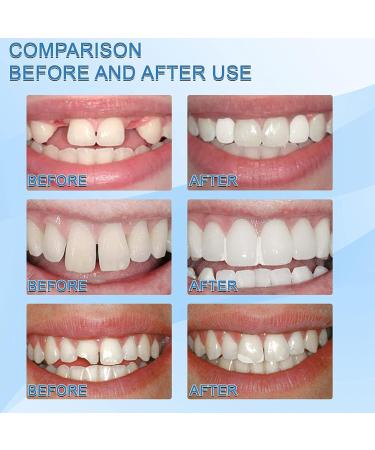 Tooth Repair Granules & Temporary Teeth Replacement Kit | Moldable Fake Teeth & Thermal Beads | Reusable Solution (10ml-1PCS) - International Shipping Available - Buy Online on GoSupps.com