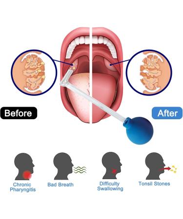 Effective Tonsil Stone Removal Tool - Fresh Breath Almond Sucker & Remover - Buy Online on GoSupps.com