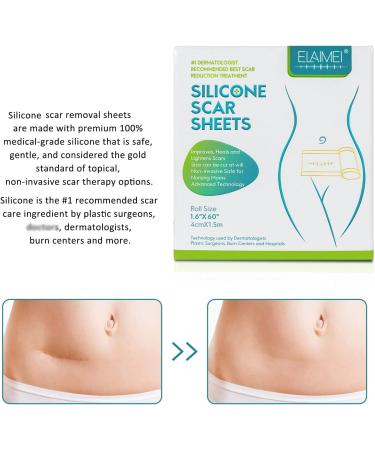 Silicone Scar Sheets - Medical Grade Removal Patches for C-Section, Surgery, Burn, Keloid, Acne - 1.6 x 60 - 1.5M - Buy Online on GoSupps.com
