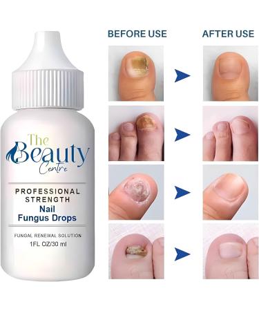 High Strength Nail Fungal Treatment by The Beauty Centre | 80% Formula for Toe and Finger Nails | Includes Free Nail File and Brush | 30ml - Buy Online on GoSupps.com