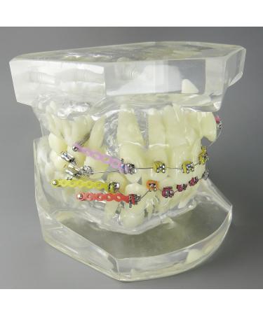 Shop Dental Malocclusion Orthodontic Treatment Model - Metal Brackets & Colorful Ties | M3005 - International Shipping Available - Buy Online on GoSupps.com