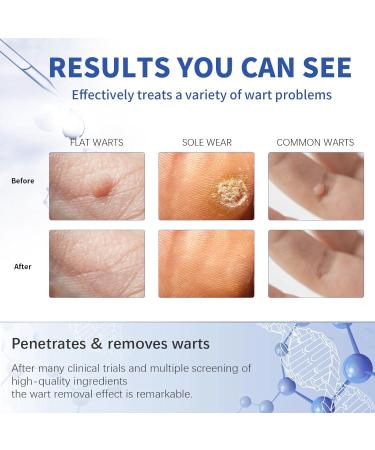 Wart Remover Liquid Fast Acting Salicylic Liquid to Remove Common and Plantar Warts Flat Warts 0.7 Fl Oz 1 Count - Buy Online on GoSupps.com