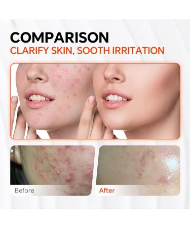 Dark Spot Corrector with 10% Azelaic Acid & Niacinamide | Acne & Rosacea Treatment | Pore Refining & Redness Relief - Buy Online on GoSupps.com