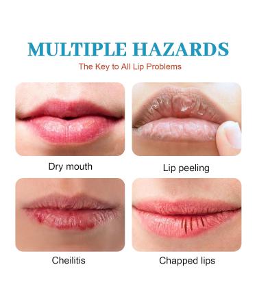 Healing Lip Balm for Dry Cracked Lips | Natural & Organic Cheilitis Treatment for Men Women & Children | Dermatologist Recommended All-Day Moisture - Buy Online on GoSupps.com
