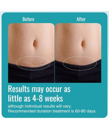 Scar Away Extra Strength Silicone Scar Sheets 4 Pack - Reusable Medical Grade Treatment for C-Section, Keloid, Surgery, Injury, and Burns - 5.7x1.57 inches - Buy Online on GoSupps.com