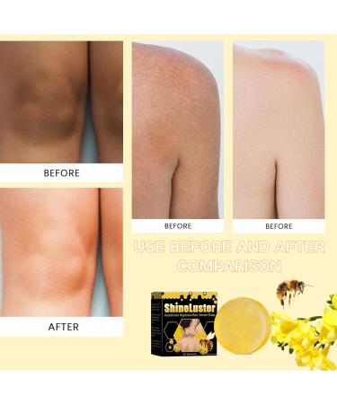 Bee Venom Soap - Natural Bee Venom Soap - Moisturizing Handmade Soap Bar for Body & Face - Bee Venom Bar for Brighten Acne Dark Spots Hyperpigmentation Smooth Skin - Buy Online on GoSupps.com