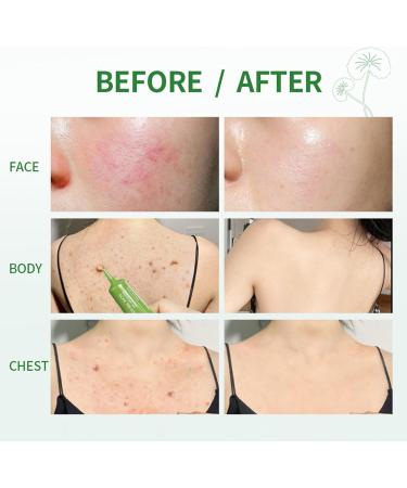 Anti Acne Face Cream 3X Centella Face Ance Gel Spot Cream for Acne Treatment and Spot Treatment Shrink Pores Acne Scars Recovery Control Sebum Secretion Relieves Redness &Anti-Bacterial - Buy Online on GoSupps.com