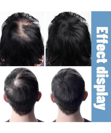 Un roll-on nourrit le cuir chevelu et les cheveux stimule les follicules pileux favorise l' paississement des et traite les probl mes de ligne frontale et de cheveux clairsem s. Convient aux - Buy Online on GoSupps.com
