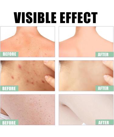 Acne Treatment Spary Back Acne Body Wash Aloe Soap for Face & Body Acne Marks Skin Care Spray Body Moisturiser For Acne Shoulder &Back Acne Reduce Back Acne& Nourishing-(Anti Acne Spray+Aloe Soap) - Buy Online on GoSupps.com