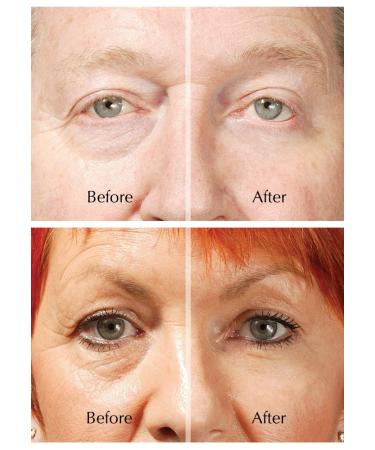ROX Eye Lifting - TV Rox Anti Eye Wrinkle Booster | International Shipping Available - Buy Online on GoSupps.com