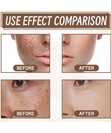 Aobenz Spot Remover for Face Dark Spot Correcting Serum Anti Spot Serum Dark Spot Remover for Face Freckle Remover Hydrating Serum Skincare Serum 50ml - Buy Online on GoSupps.com