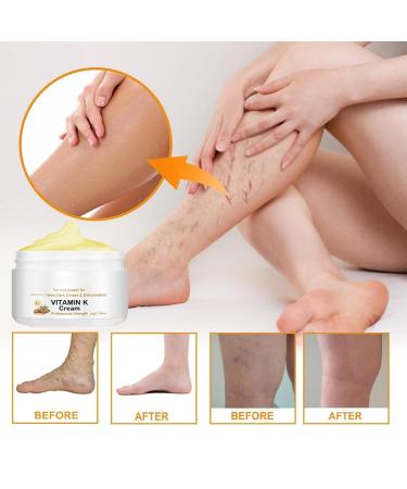 Varicose Veins Miracle Cream - Circulheal Vitamin K Cream (3 PCS) | Best Treatment for Varicose Veins - Buy Online on GoSupps.com