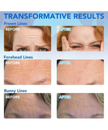  Frovetani Pack of 16 anti-wrinkle forehead plasters with aloe collagen and vitamin E anti-wrinkle treatment for forehead wrinkles - Buy Online on GoSupps.com