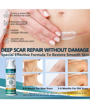 Geloo Advanced Scar Cream Gel 50g - Silicone Gel for Scar Treatment - For Face & Body, Surgical Scars, Stretch Marks, Acne, Keloids, Burns - 1.7 oz - Buy Online on GoSupps.com