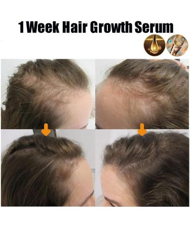  homomdy Lidoria 7 Day Ginger Hair Loss Oil Hair Growth Oil Anti Hair Loss Serum Natural Ginger Hair Growth Germ Serum (2PCS) - Buy Online on GoSupps.com