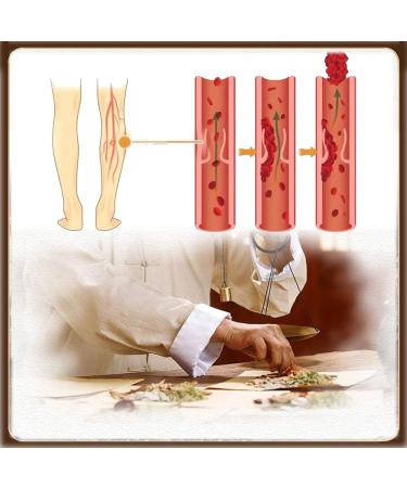 24 PCs Varicose Vein Patch | Remove Spider Veins & Improve Leg Appearance | Enhance Blood Flow & Relieve Inflammation | International Shipping Available - Buy Online on GoSupps.com