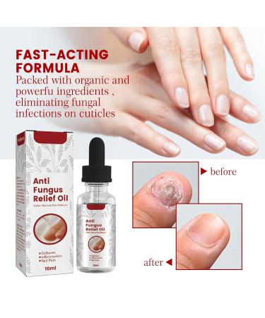 Foot Corn Remover Gel - Effective Foot Corn Removal Treatment for Cracked, Dead Dry Skin - Fits All Foot Sizes (3 pcs) - Buy Online on GoSupps.com