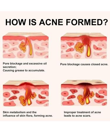 Chinese Herbal Acne Treatment Cream Natural Extract Acne & Spot Treatment for Face Acne Cream & Spot Cream for Face Pimple Cream for All Skin Types Smooth Gentle Acne Repair Oil Control - Buy Online on GoSupps.com