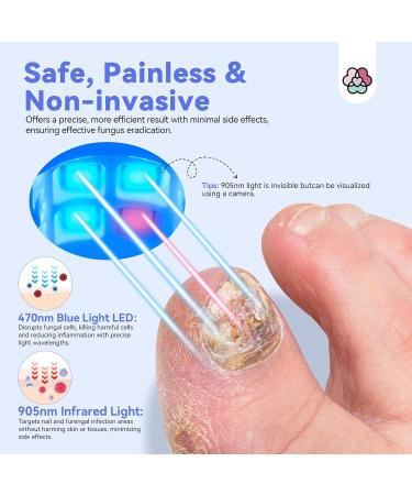 SAVILAND Nail Fungus Cleaning Device Faster: Max-Effective 905nm Infrared Light 470nm Blue Light Defeat Fungi Nail Fingernail Fungus Toenail Fungus Safer Painless Rechargeable Fungi Cure Home Use - Buy Online on GoSupps.com