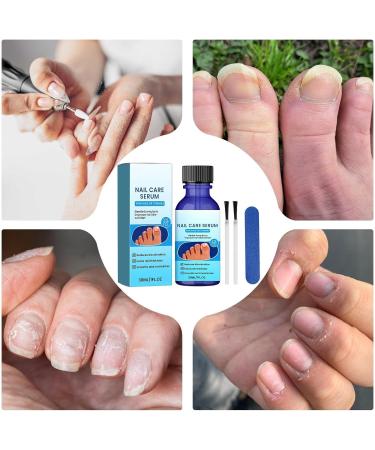 S rum de soin des ongles renforce et nourrit 30 ml traitement contre l s champignons des ongl s d s pieds soin d s ongles contre les champignons r duit la d coloration les cuticules s ch - Buy Online on GoSupps.com