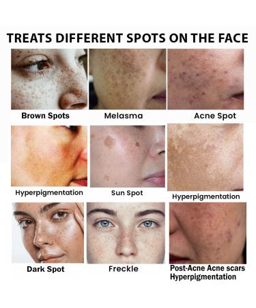 Dark Spot Remover Serum for Face with Vitamin C, Retinol, Salicylic Acid & More - Hyperpigmentation & Acne Scar Treatment - Buy Online on GoSupps.com