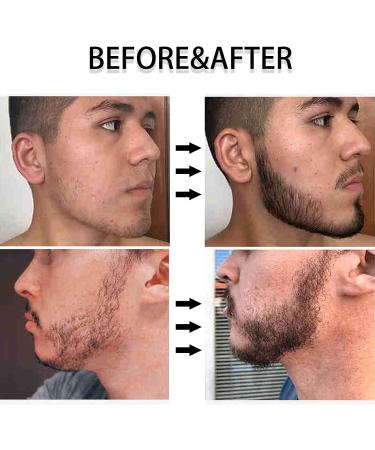Beard Roller for Growth Derma Roller 0.5MM 540 Titanium Needles Microneedle Tool for Face Body Skin Care Beard Hair Growth (0.5MM) - Buy Online on GoSupps.com