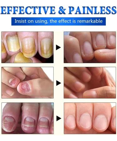 Nail Fungus Treatment for Toenail - 7 Day Fungal Nail Treatment for Toenails Extra Strong - Fungal Nail Treatment - Toenail Fungus Treatment for Thickening Yellow-Brown Discoloration Ragginess 10ML - Buy Online on GoSupps.com