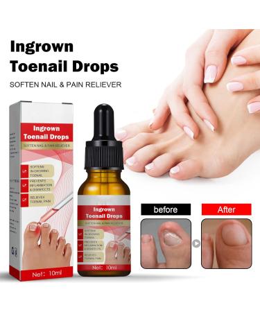 Ingrown Toenail Treatment Oil - Natural Solution for Ingrown Toenails & Fungal Nail Care | 1PCS - Buy Online on GoSupps.com