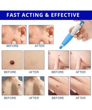 GIMOCOOL Auto Skin Tag Remover kit Skin Tag Treatment Anti-skin Tag Pen Skin Wart Removal Device 2-8mm 2 in 1 for Removing Face Body Warts - Buy Online on GoSupps.com