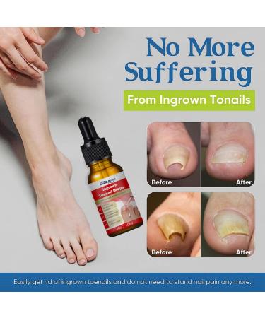 Ingrown Toenail Treatment Oil - Anti Paronychia Relief & Nail Growth Formula - Buy Online on GoSupps.com