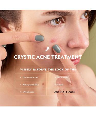 Anti Acne Face Cream Spot Cream For Acne Treatment & Spot Treatment Pimple Treatment Gel Reduces Redness & Moisturiser Acne Cream For Face Blemishes and Blackheads. - Buy Online on GoSupps.com