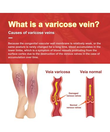 4 & 12 Pieces of Venous Plaster for Varicose & Spider Veins - Improve Blood Circulation & Calm Vasculitis - International Shipping - Buy Online on GoSupps.com