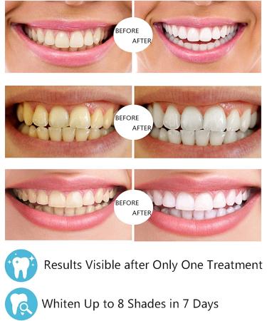 IDOLUSTER Teeth Whitening Kit with LED Light & 3 Whitening Pens - Professional Tooth Whitener for Sensitive Teeth - Buy Online on GoSupps.com