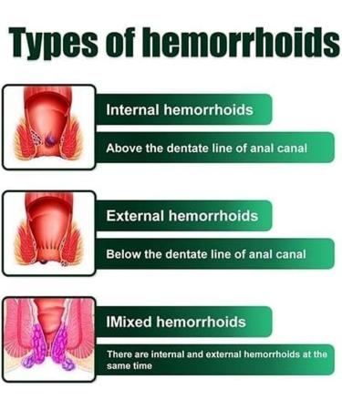 Hemorrhoids Cream - Hemorrhoid & Fissure Relief Cream Natural Hemorrhoids Treatment Cream Hemorrhoids Treatment Removal Cream Fast Acting Relief from External Itching and Burning (1 Pcs) - Buy Online on GoSupps.com