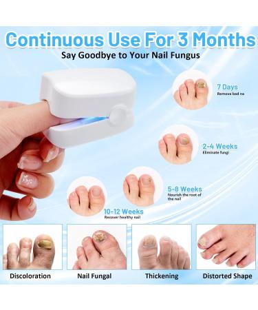 Portable Nail Fungus Laser Treatment Device | Light Therapy for Onychomycosis | Painless Home Use - Buy Online on GoSupps.com