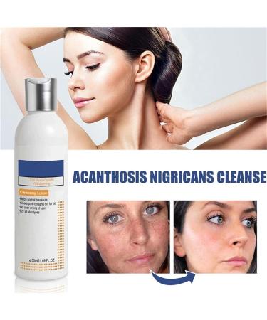 BIERELAOZI Skinenjoy Cleansing Lotion for Acne & Spots - Acanthosis Nigricans Therapy Cream | Dark Spot Remover for Face & Body (1 PC) - Buy Online on GoSupps.com