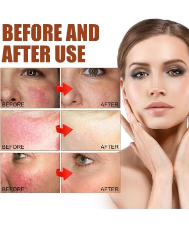 Rosacea Face Serum Anti Redness Face Serum for Women Relieve Redness & Acne Mark Dark Spot Correcting Glow Serum Anti Aging Serum for Face Hydrating Face Serum Skin Care for Women Dark Spots Remover - Buy Online on GoSupps.com