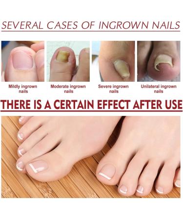 Ingrown Toenail Treatment Nail Helper Nail Growth Treatment Ingrowing Toenail Treatment Ingrown Toenail Corrector Treatment For Ingrown Toenail Ingrowing Toenail Cuticle Oil Nail Growth Treatment - Buy Online on GoSupps.com