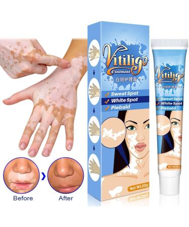 EXQST Vitiligo Care Cream - Targeted Treatment for Even Skin Tone - Buy Online on GoSupps.com