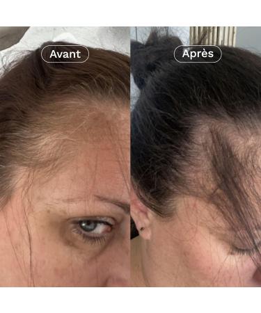 OMUM - In&Out Hair Duo Gift Box: 1 Organic Boost Lotion + 1 Anti-Hair Loss Food Supplement - Stimulates hair growth strengthens from 45 days - Natural France Vegan - Buy Online on GoSupps.com