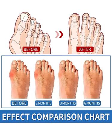 OBODN 6 Pcs Orthopedic Bunion Corrector Splint Toe Separator & Pain Relief - Buy Online on GoSupps.com